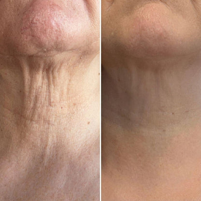 MASAJEADOR/Antiarrugas Rodillo 3D Integrado - Específico para cuello y rostro - Tratamiento Antiarrugas \ Jaysuing